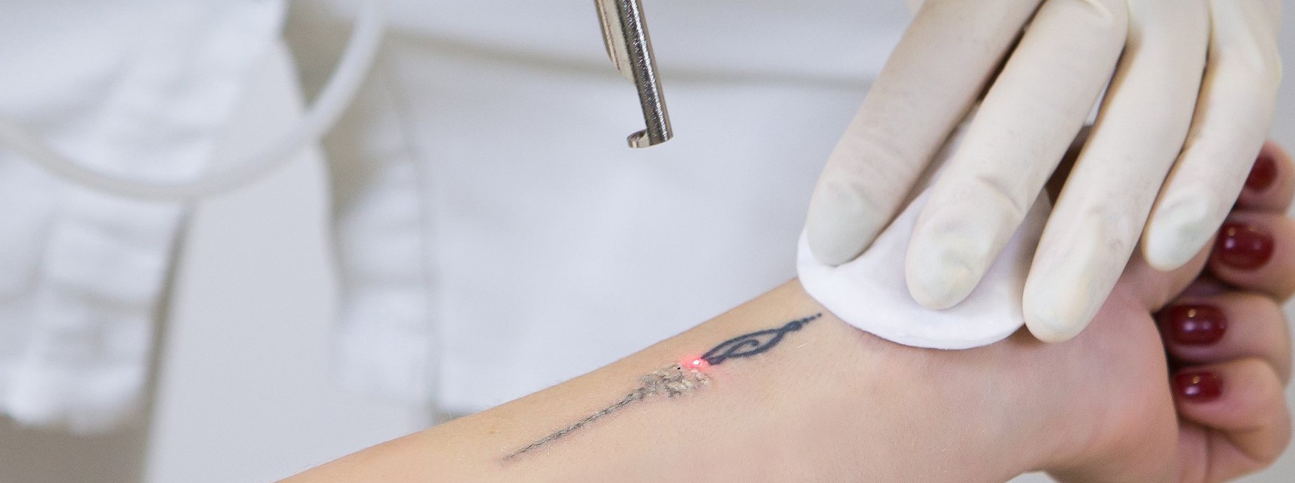 pico laser op arm met tatoeage