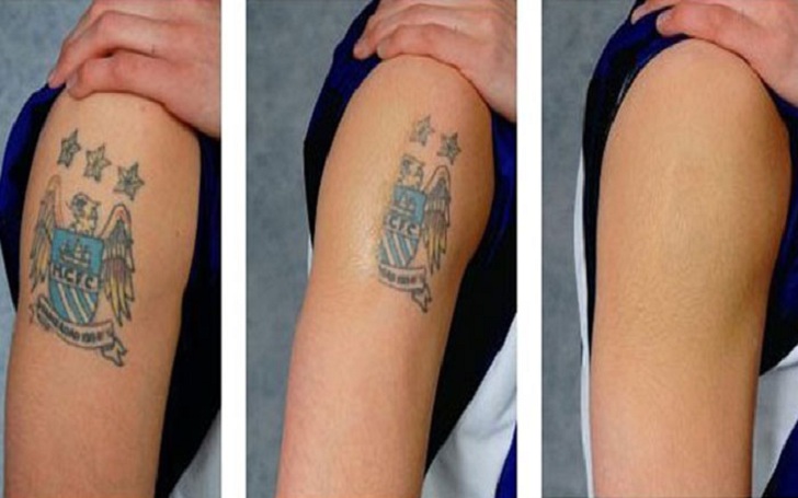 tatoeage verdwijnt in drie stappen door laser